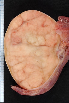 23testiclecancer_230x346 23testiclecancer_230x346